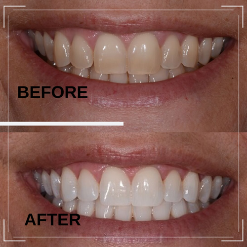 Teeth Whitening before and after example 1
