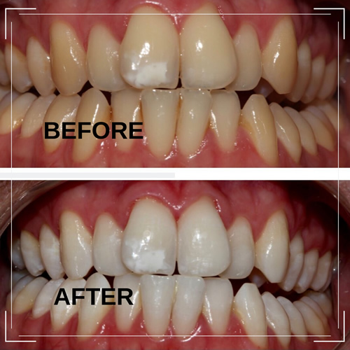 Professional teeth whitening near me before and after case study