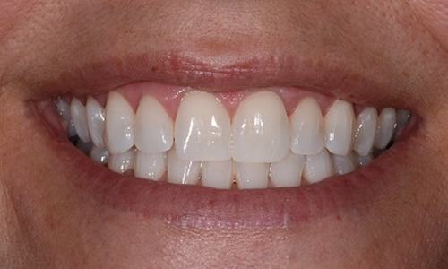 Cosmetic dentist Cheshire results