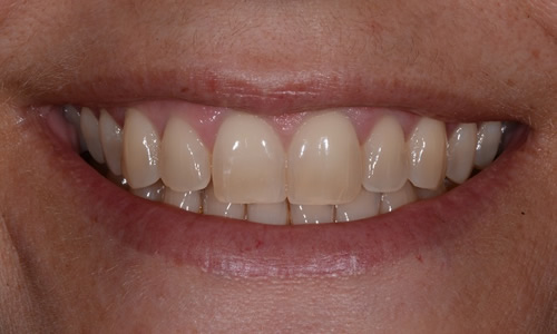 Teeth Whitening example before cosmetic dentistry