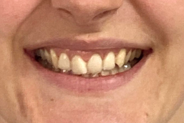 Before invisalign teeth straightening 