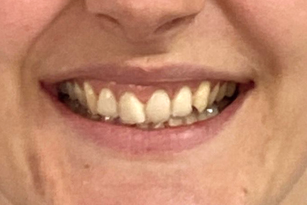 Before teeth straightening near me