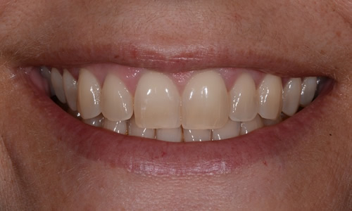 Teeth whitening example before treatment