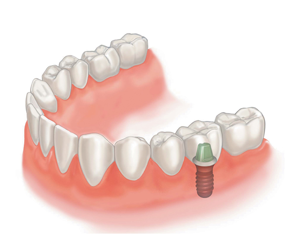 cheap dental implant near me with supported crown